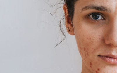 Microomics publica dos artículos sobre la importancia de la microbiota en el tratamiento del acné